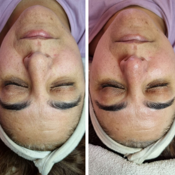 HIGIENE + DERMAPLANING + DERMAPEN + RF