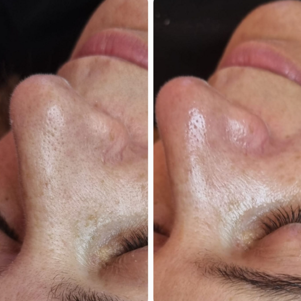 HIGIENE FACIAL + DERMAPLANING