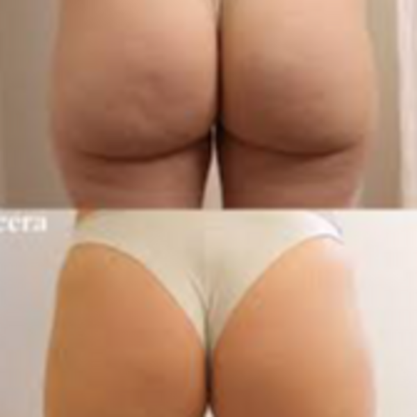 Bioestimulación con SCULPTRA para celulitis x 2 ampollas (ambas piernas)