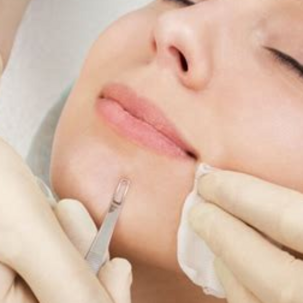 EXTRACCIONES DE IMPUREZAS