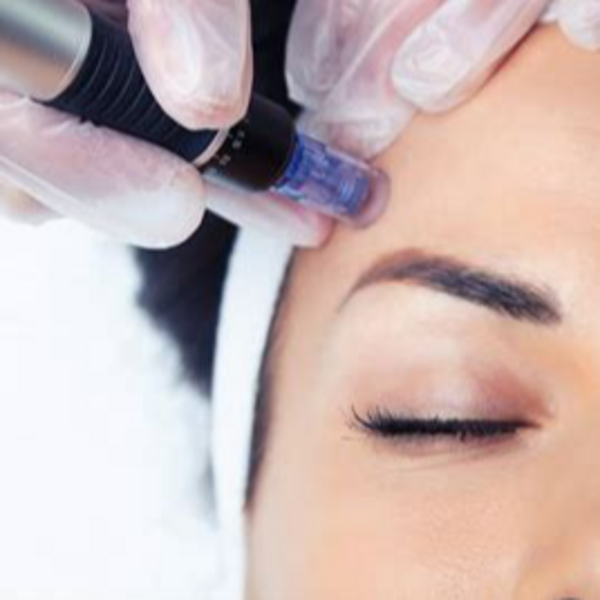 MICRONEEDLING