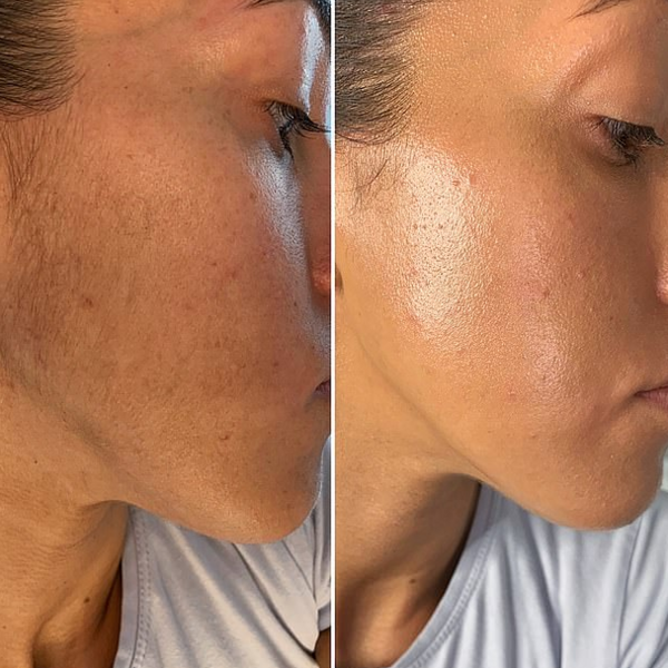 Facial + Dermaplaning