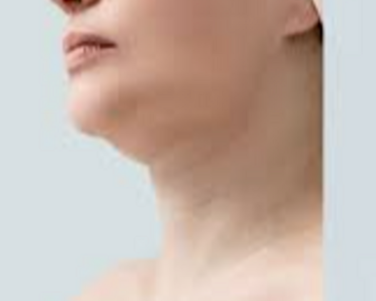 Tratamiento para papadas $65.000 HASTA 3 CUOTAS s/INTERES