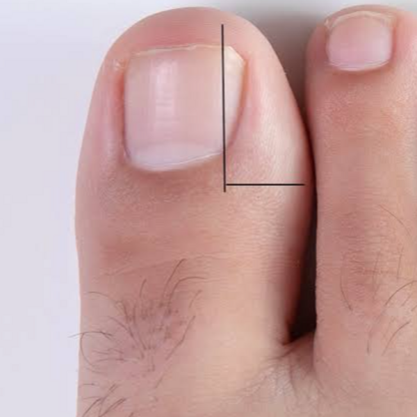 Corte de Uña Encarnada