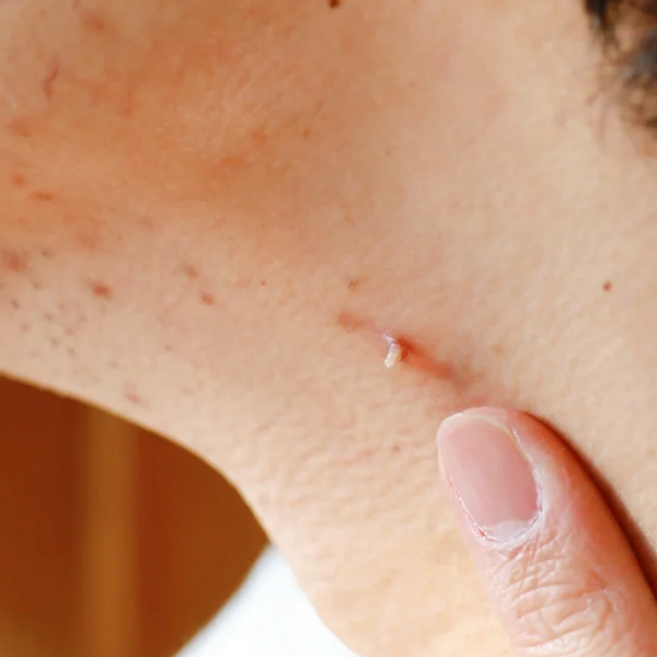 Eliminación de Verrugas ( de 1 a 10)