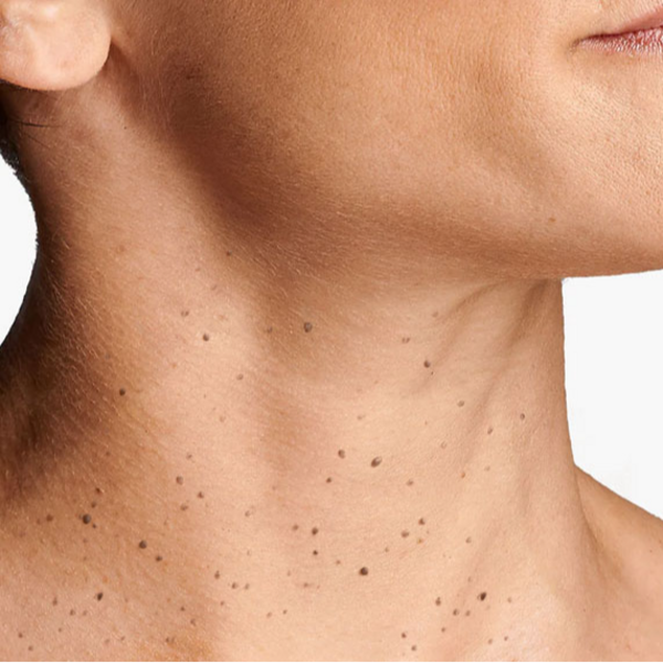 Eliminación de Verrugas ( de 11 a 20)