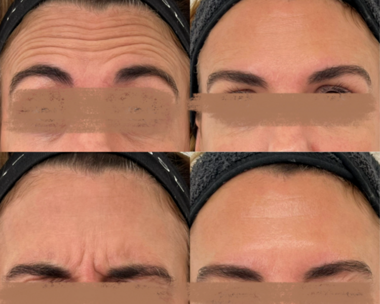 Botox - Toxina Botulínica - TERCIO SUPERIOR FACIAL (3 zonas)