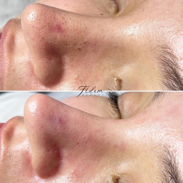 Limpieza Facial Profunda 