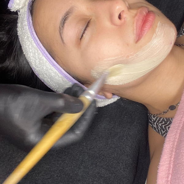 Peeling x 4 sesiones