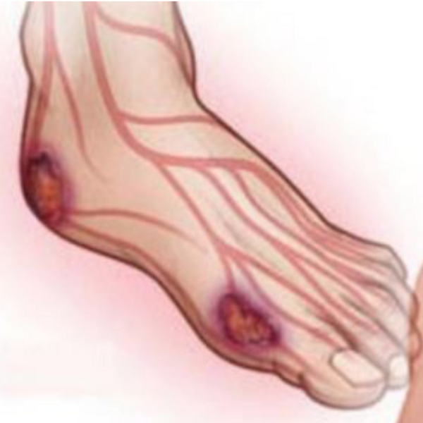 Embolsados de Ozono para Extremidades (+ Curación de heridas)