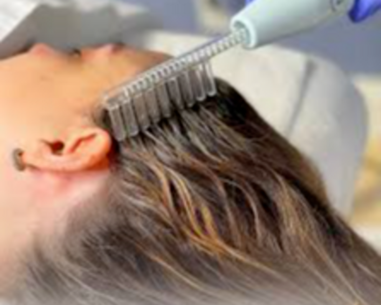 Tratamiento con Alta Frecuencia Capilar $65.000 - Hasta 3 CUOTAS s/INTERES