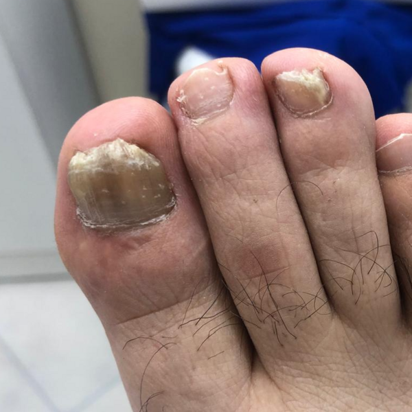 Podología c/ Micosis y/o Atrofia e Hipertrofia Ungueal (uñas) Micosis Piel 