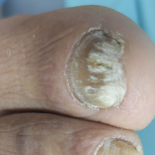 Podología c/ Micosis y/o Atrofia e Hipertrofia Ungueal (uñas) Micosis Piel 