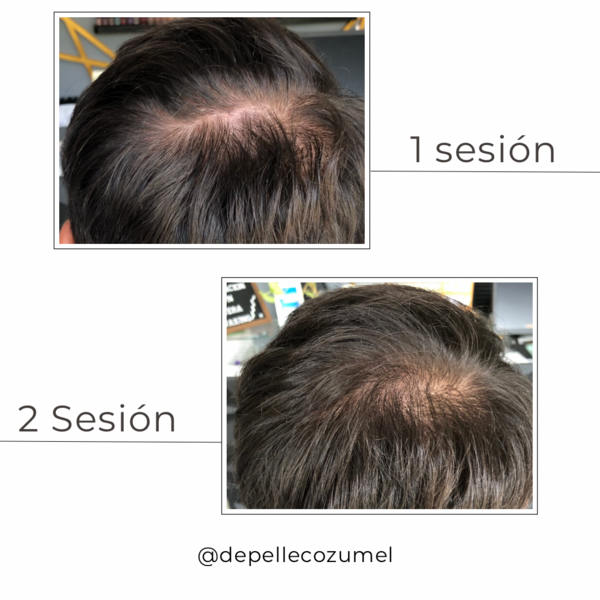 Regeneración capilar/hair regeneration