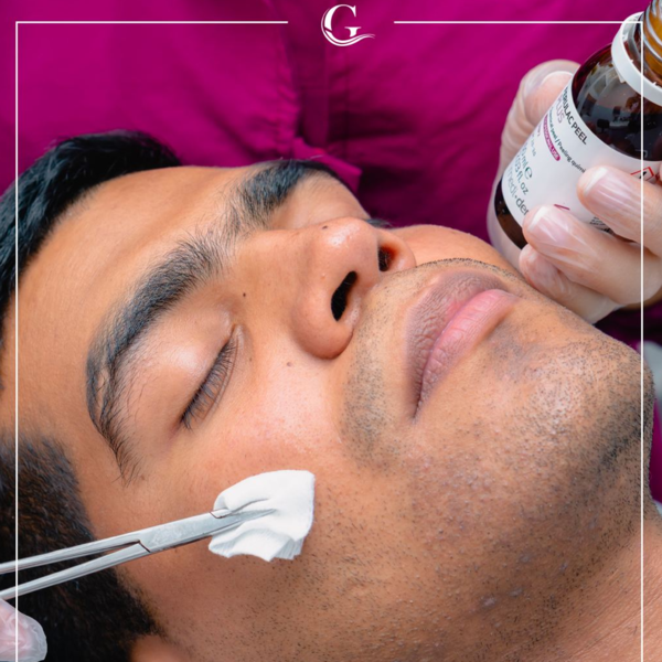 Peeling Facial ( piel renovada)
