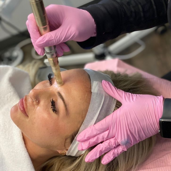 Microneedling con Dermapen Vitaminas 