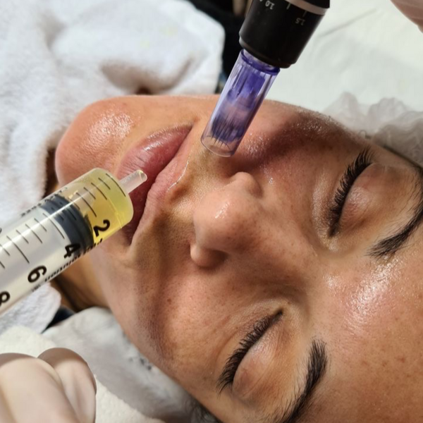 Microneedling con Dermapen Vitaminas 