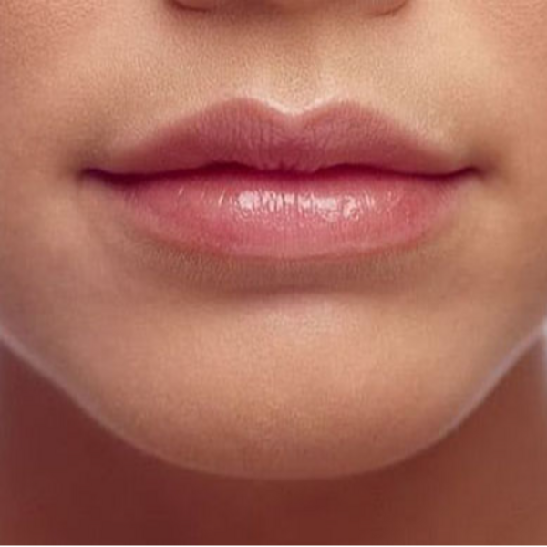 Aumento o Perfilamiento de Labios