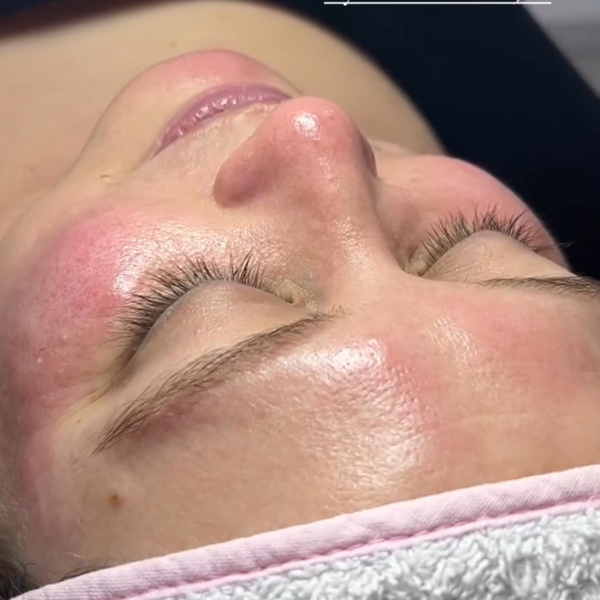 Tratamiento Nueva piel (Todo o nada)