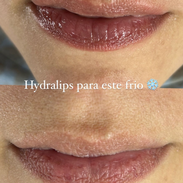 Hydra lips con dermapen