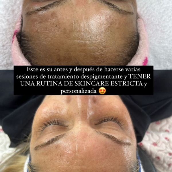 Tratamiento despigmentante intensivo