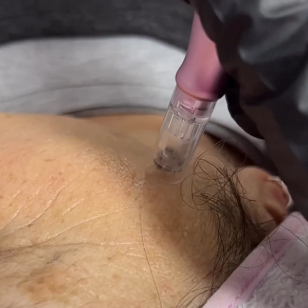 Tratamiento regenerador de colageno - Dermapen con micropunciones