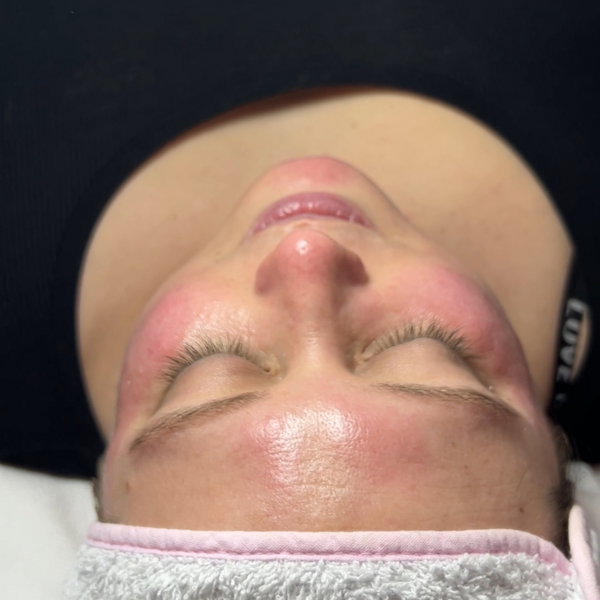 Tratamiento pieles sensible o con rosácea