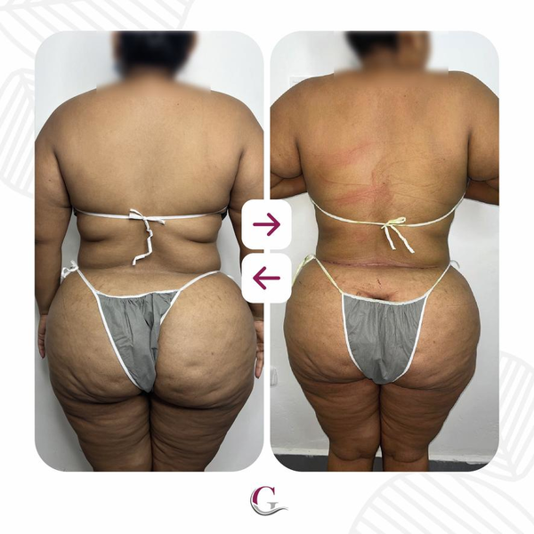 Paquete Reducción Abdomen Cintura (10 Sesiones) 