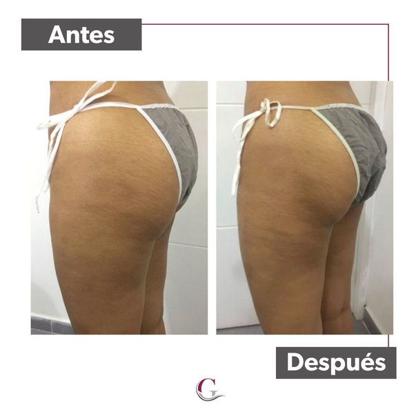 Paquete Levantamiento de gluteos (10 sesiones) 