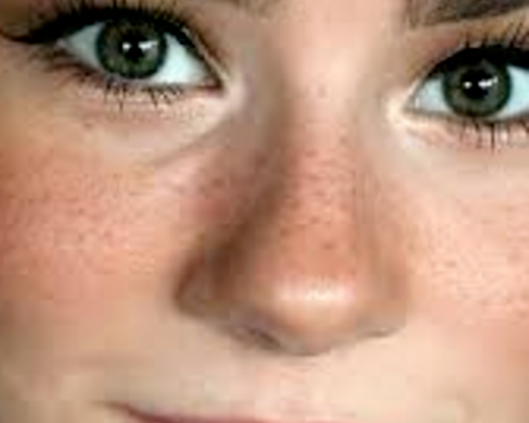 Freckling( micropigmentacion de  pecas)